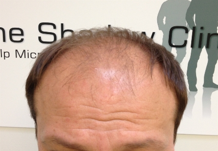Treatments for Male Pattern Baldness (Male Pattern Hair Loss) & Balding Cure