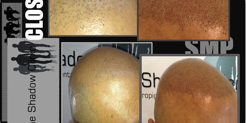 SMP Giving Hair Transplant a Boost SMP Giving Hair Transplant a Boost