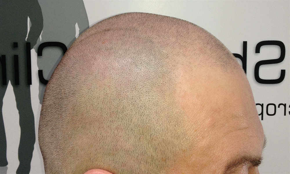 Scalp Micro Pigmentation Treatment by The Shadow Clinic