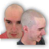 Receding Hair Line Image