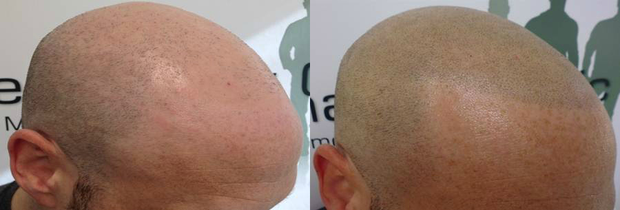 scalp micropigmentation adelaide