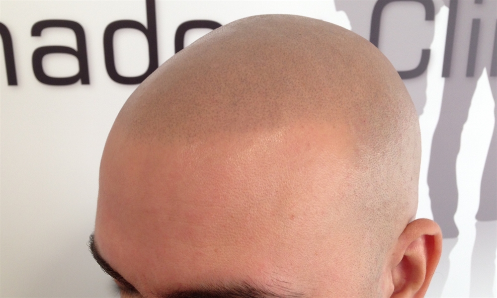 Scalp Micro Pigmentation by The Shadow Clinic