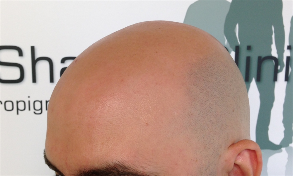 Before and After image of Scalp Micro Pigmentation treatment by The Shadow Clinic Client