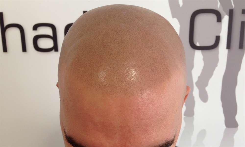 After image of Scalp Micro Pigmentation treatment by The Shadow Clinic Client