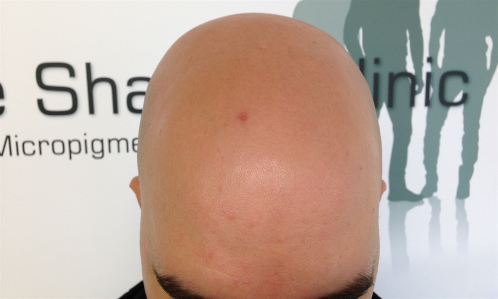 Scalp Micro Pigmentation by The Shadow Clinic